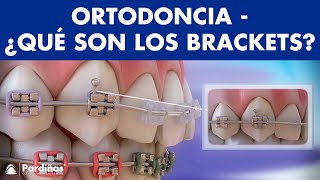 Ortodoncia – Brackets y otras partes del aparato dental © [upl. by Haianeb]