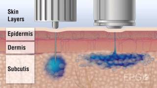 Needle vs InsuJet™ Nozzle injection [upl. by Norbert98]