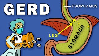 Gastroesophageal Reflux Disease GERD [upl. by Almita465]