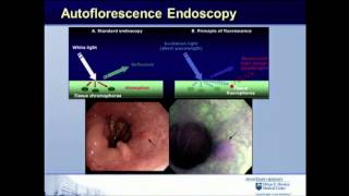 Classification and imaging in Barretts esophagus  Endoscopic Management of GEJ Disease [upl. by Mogerly]