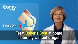 Bakers Cyst Treatment  What you need to know [upl. by Calypso]