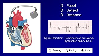 Pacemaker Modes and Settings [upl. by Nnitsuj]