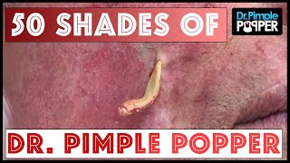 Dr Lee Removes A Massive 55 Year Old Blackhead  Dr Pimple Popper [upl. by Nolahp]