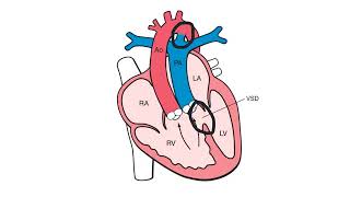 Double Outlet Right Ventricle [upl. by Sunil]