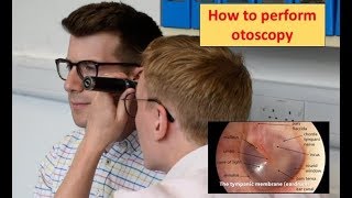 How to perform Otoscopy Ear Exam [upl. by Hersh]