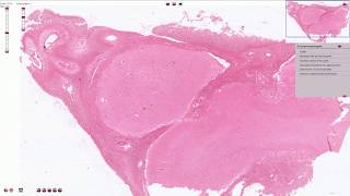 Purulent Meningitis  Histopathology [upl. by Zandt]