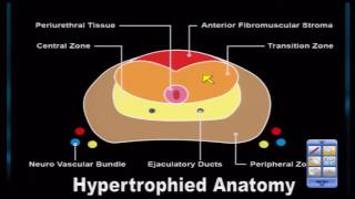 Prostate MRI Case Review A Continued Look at Anatomy [upl. by Eilatan59]