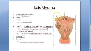 Pathology 721 a Leiomyoma FIBROID uterus fibromyoma Smooth muscle benign Gross specimen Practical [upl. by Alehc]