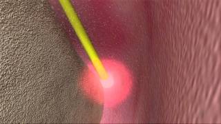 Laser Periodontal Therapy  WPT™ Animation [upl. by Charbonneau]