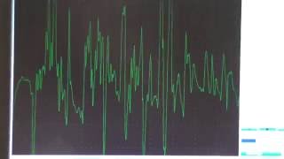 Myopathy EMG changes explained [upl. by Ephraim]