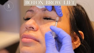 Botox Brow Lift [upl. by Supat689]