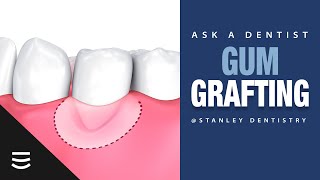 Ask a Dentist Gum Grafting 101 [upl. by Rowen]