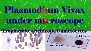 Plasmodium Vivax under microscope TrophozoitesSchizontGametocytesclear explain [upl. by Portie]