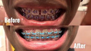 FULL BRACES JOURNEY 1 amp 12 YEARS GAPS SMALL OVERBITE CHAINS AND OVERALL EXPERIENCE [upl. by Coe163]