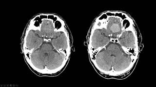 Meningioma [upl. by Hime]