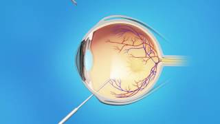 Macular Pucker Vitrectomy Surgery [upl. by Oretos]