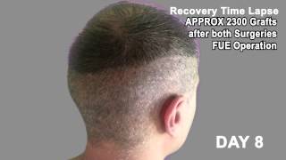 Hair Transplant Review 2013 19 DAY RECOVERY TIME LAPSE OF DONOR AREA POST OP [upl. by Ecitnirp293]