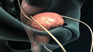 Transurethral Resection of the Prostate TURP [upl. by Ivy]