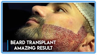 FUE Surgery Beard Transplant Amazing Results BeforeAfter [upl. by Ailat782]