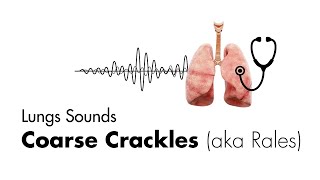 Coarse Crackles Rales  Lung Sounds  Medzcool [upl. by Suhsoj]