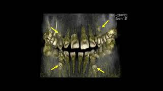 Supernumerary teeth [upl. by Gaylord677]