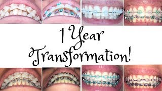 My 1 Year Braces Journey [upl. by Asiak683]