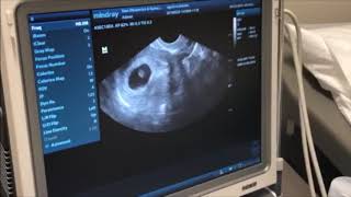 Pregnancy ultrasound at 6 weeks [upl. by Sheelah]