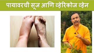 पायावरची सूज आणि व्हेरिकोज व्हेन  दामले उवाच भाग १८५  Remedy for Varicose Vein [upl. by Isayg]