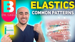 BRACES ELASTICS Most Common Patterns for Braces [upl. by Josephson550]