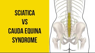 Sciatica vs Cauda Equina Syndrome MEDICAL EMERGENCY [upl. by Rosetta]