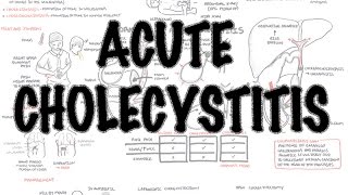 Acute Cholecystitis  Overview signs and symptoms pathophysiology treatment [upl. by Yeslek]