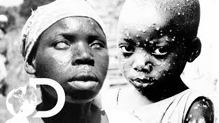 The Eradication Of Smallpox  Invisible Killers [upl. by Nitsruk]