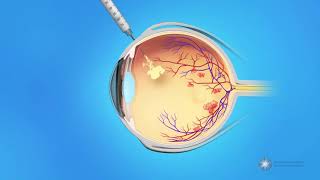 OCT Interpretation Session 4 Retinal Vascular Disease [upl. by Cheshire960]