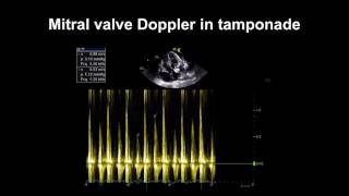 Echocardiography Essentials Detecting pericardial effusions [upl. by Apur588]