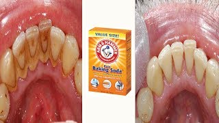 How to Remove Dental Plaque and Tartar at Home [upl. by Haerb]