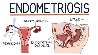 Understanding Endometriosis [upl. by Gnemgnok645]