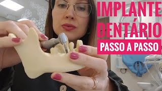 Implante Dentário Passo a Passo l Dra Danielle Sales [upl. by Fagen]