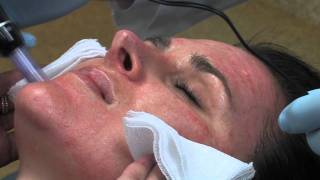 Dr Mark B Taylor Review of Dermapen Micro Needling  Gateway Aesthetics [upl. by Angadresma]