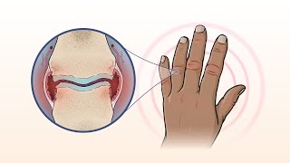 What Is Rheumatoid Arthritis  NEJM [upl. by Ahsakal892]