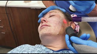 Full Face Fractional CO2 Laser Resurfacing for Wrinkles and Skin Tightening [upl. by Stockwell696]