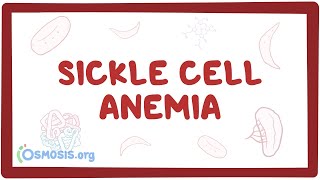 Sickle cell anemia  causes symptoms diagnosis treatment amp pathology [upl. by Glynda]