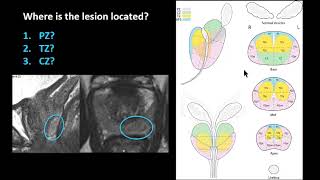 ISMRM MR Academy  Prostate MRI Image Interpretation [upl. by Cecilio]