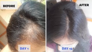 OMG  15 Days Hair Growth Miracle Treatment  Grow Long Thicken Hair  100 works [upl. by Akinwahs572]