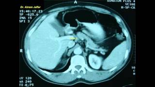 Cross sectional and imaging anatomy of the abdomen [upl. by Tav]