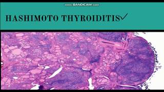 HASHIMOTOS Thyroiditis 5 Things YOU Need to Know 2024 [upl. by Aneeuq]