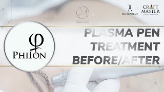 Plasma pen treatment beforeafter [upl. by Weitzman281]