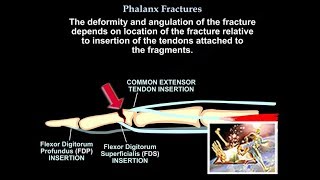 Phalanx Fractures  Everything You Need To Know  Dr Nabil Ebraheim [upl. by Prospero]