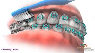 Life with Braces  Brushing amp Flossing [upl. by Oech298]