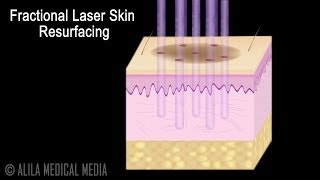 Full Face Fractional CO2 Laser Resurfacing for Wrinkles and Skin Tightening [upl. by Rratsal]