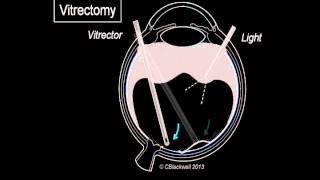 Vitreous 3 Vitrectomy Surgery [upl. by Hernandez496]